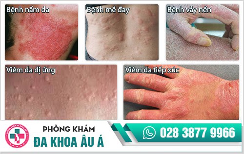 Ngứa khắp người