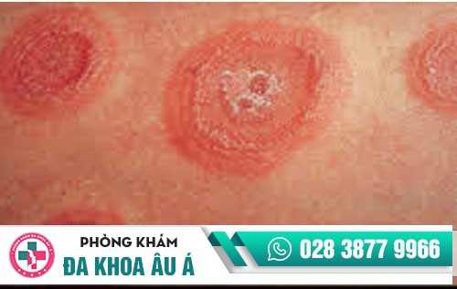 Chữa lác đồng tiền như thế nào hiệu quả, an toàn