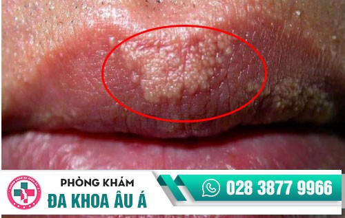 Môi nổi hạt trắng nhỏ là biểu hiện của bệnh gì?