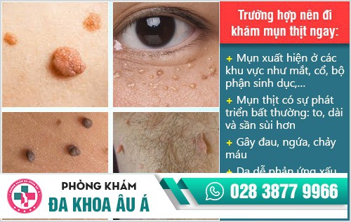 Địa chỉ chữa mụn thịt uy tín