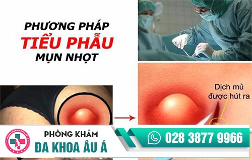 Tiểu phẫu mụn nhọt bằng công nghệ tiên tiến