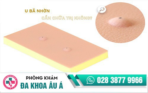Tổng quan về u nang bã nhờn, nguyên nhân và cách điều trị